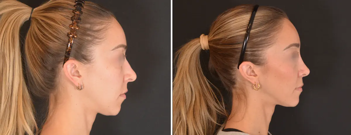 A 001 Rhinoplasty