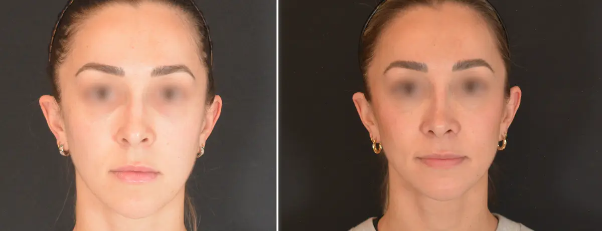 A 002 Rhinoplasty