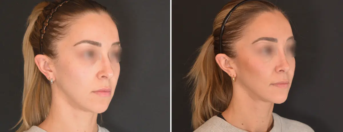 A 003 Rhinoplasty