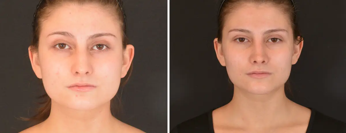 B 001 Rhinoplasty