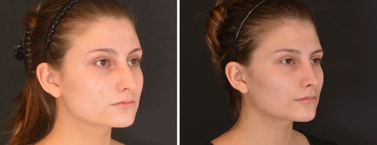 B 002 Rhinoplasty