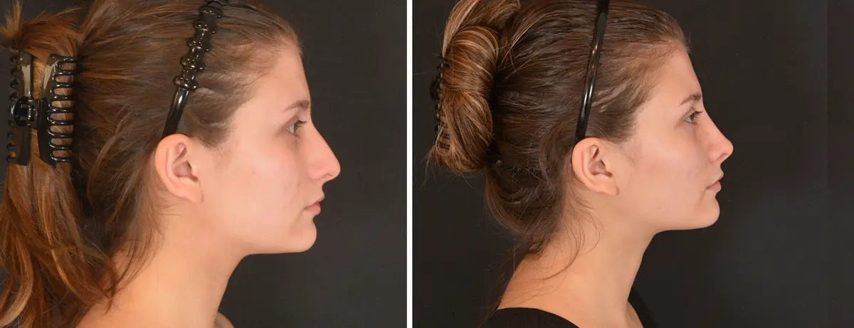 B 003 Rhinoplasty