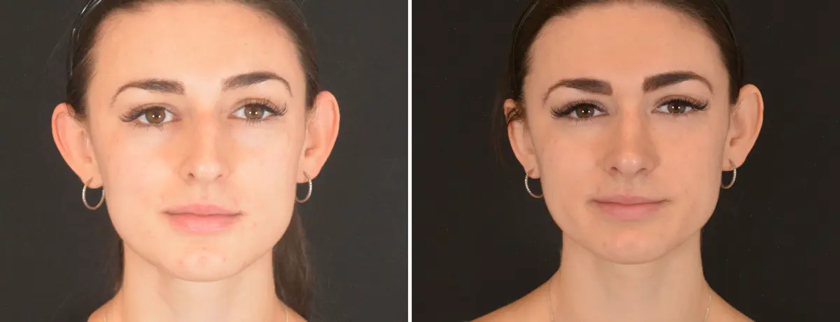 C 001 Rhinoplasty