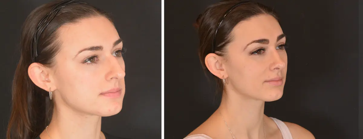 C 002 Rhinoplasty