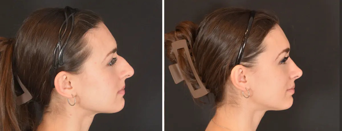 C 003 Rhinoplasty
