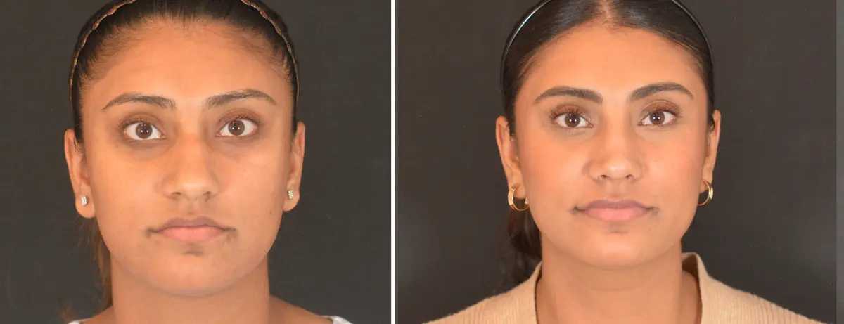 D 001 Rhinoplasty