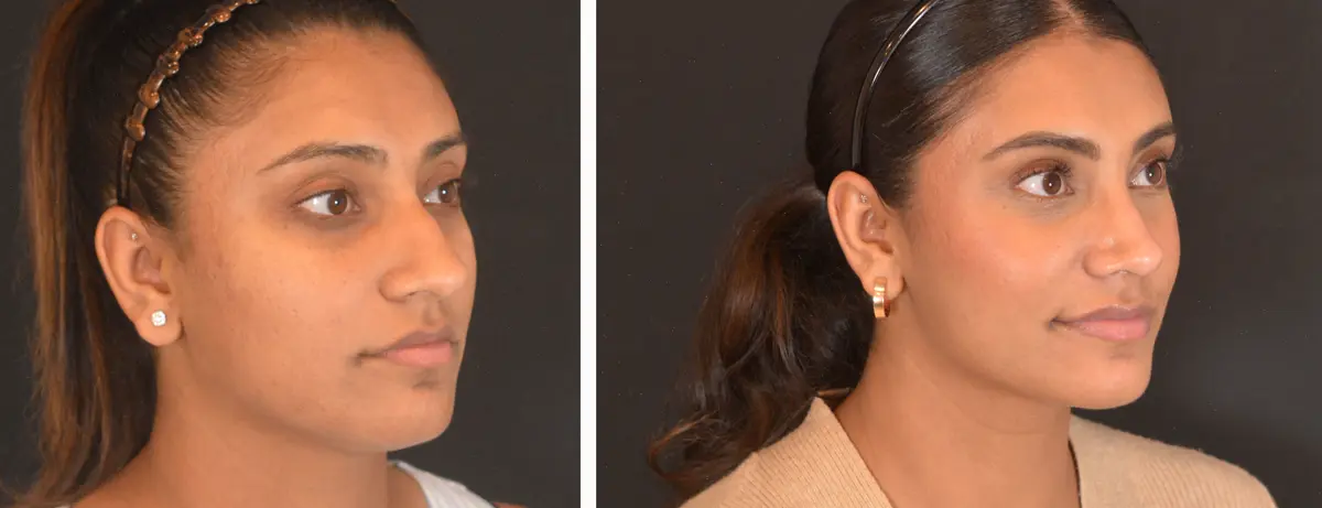D 002 Rhinoplasty