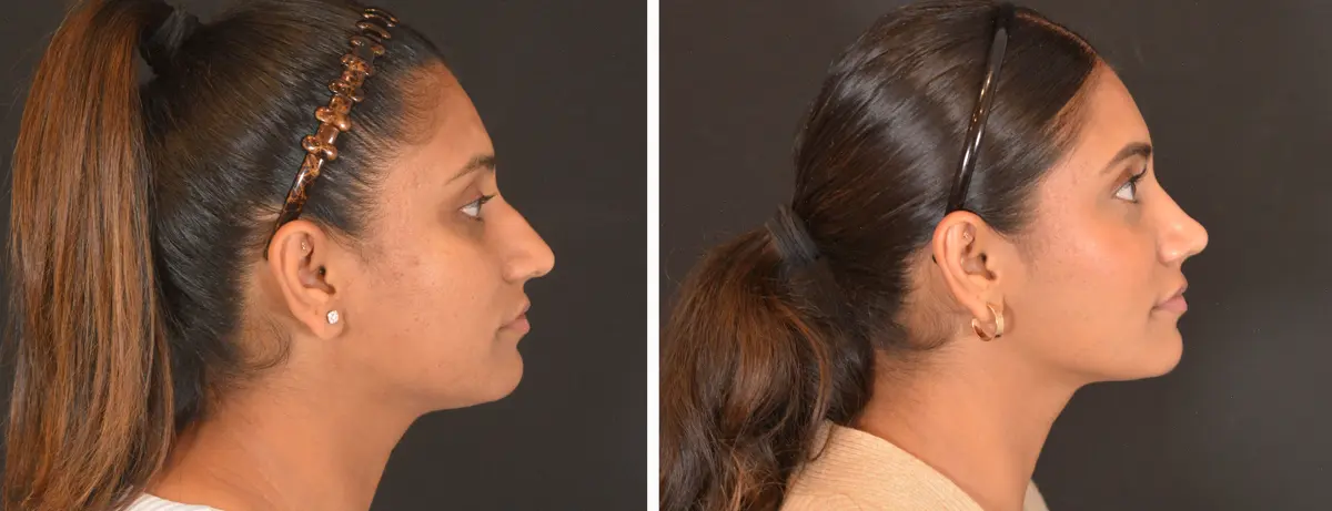 D 003 Rhinoplasty