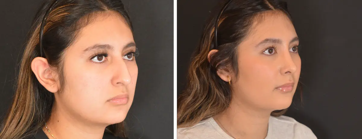 E 002 Rhinoplasty