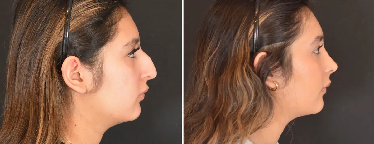 E 003 Rhinoplasty