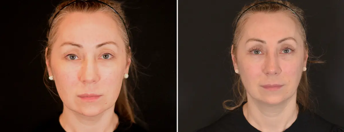 F 001 Rhinoplasty