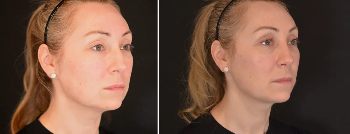 F 002 Rhinoplasty