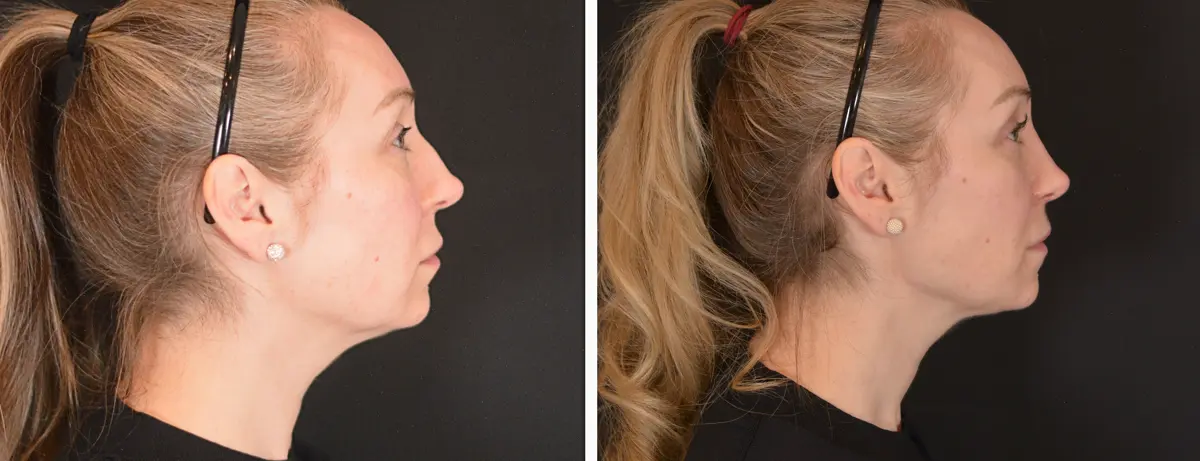 F 003 Rhinoplasty