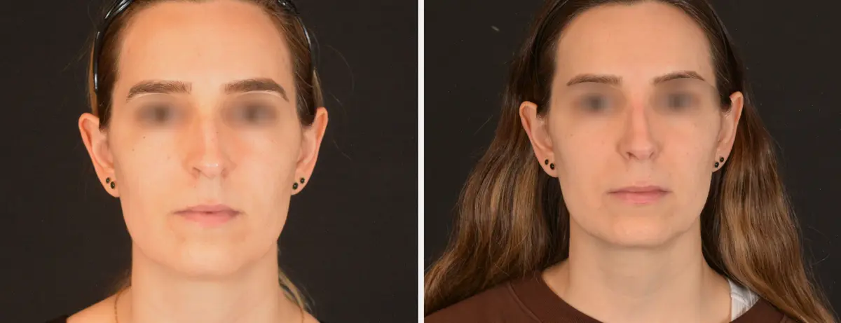 J 001 Rhinoplasty