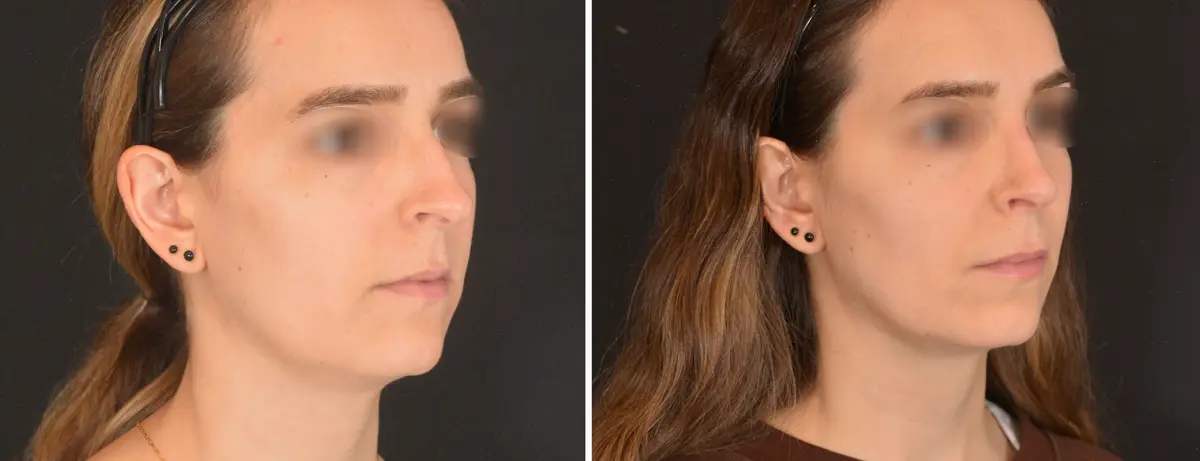 J 002 Rhinoplasty