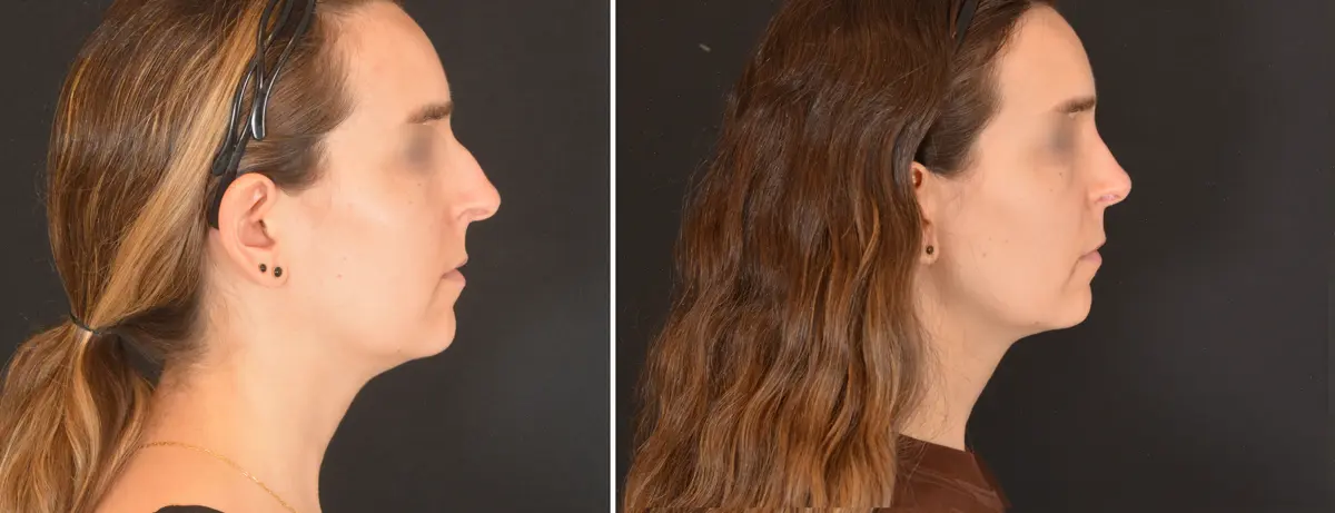 J 003 Rhinoplasty
