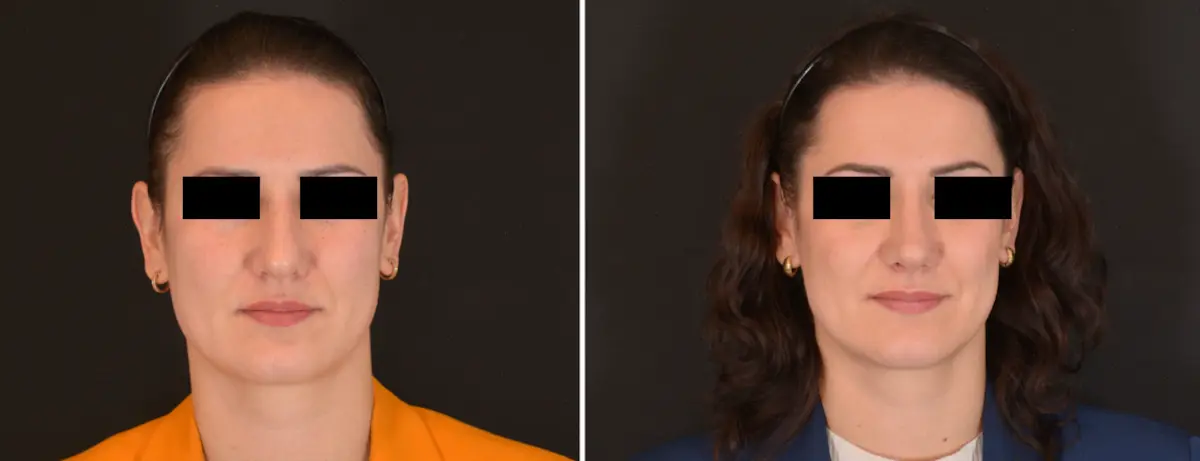 K 001 Rhinoplasty