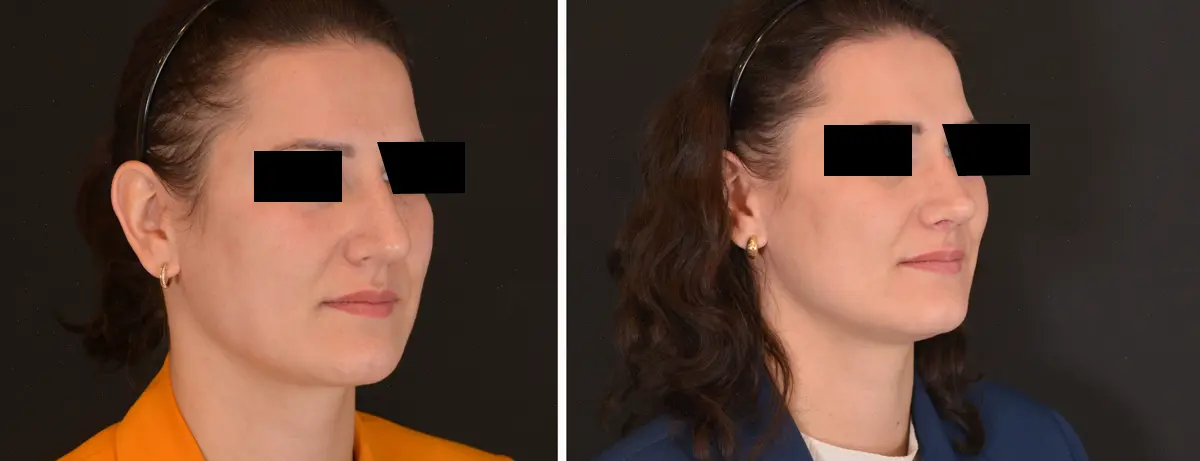 K 002 Rhinoplasty