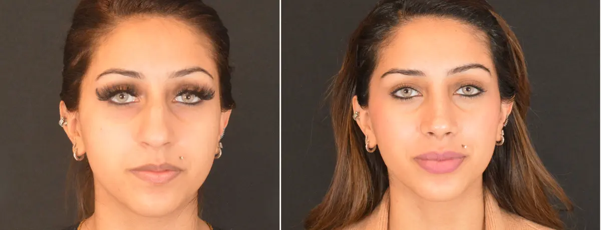 L 001 Rhinoplasty