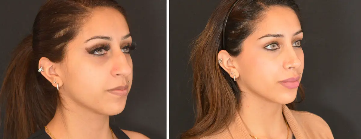 L 002 Rhinoplasty
