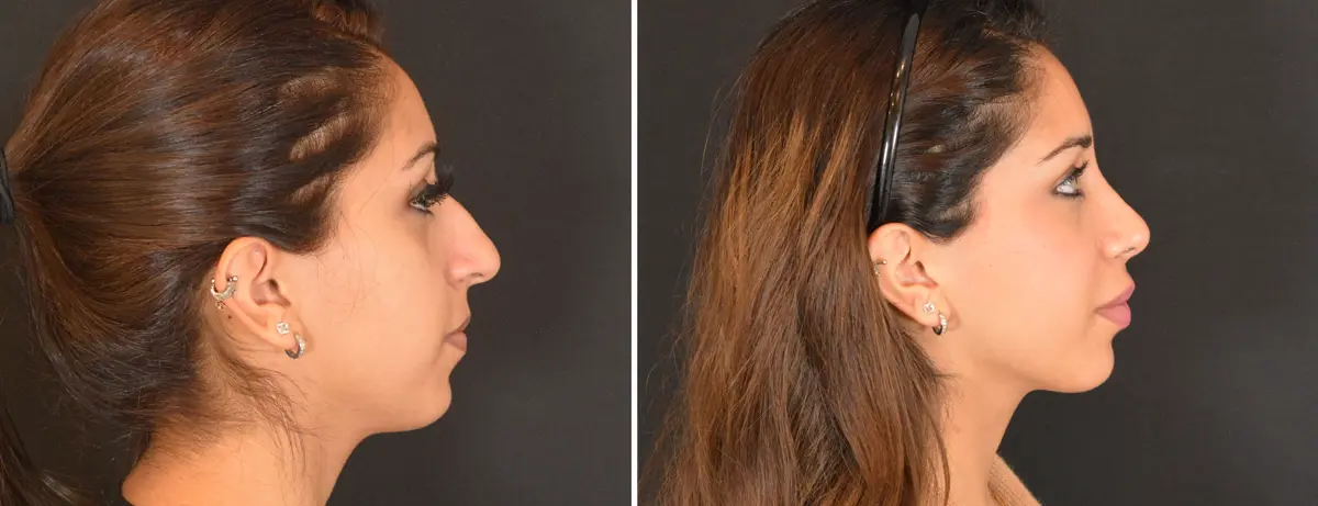 L 003 Rhinoplasty