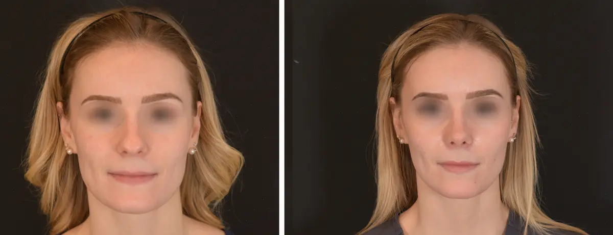 N 001 Rhinoplasty