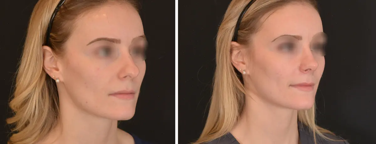 N 002 Rhinoplasty