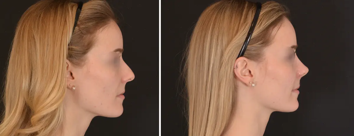 N 003 Rhinoplasty