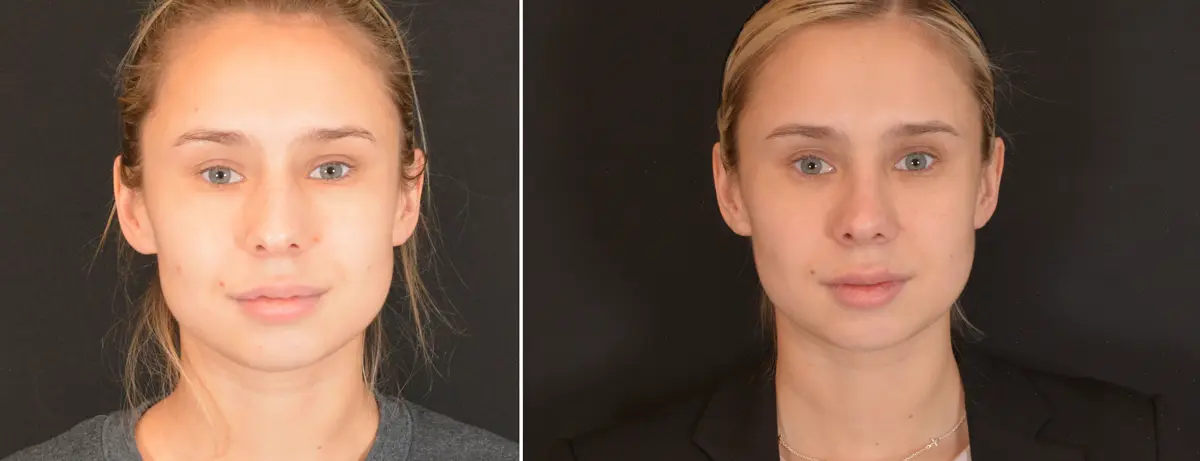 O 001 Rhinoplasty