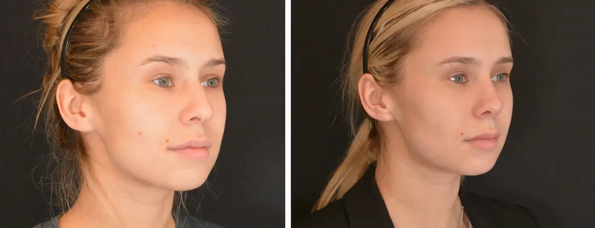 O 002 Rhinoplasty
