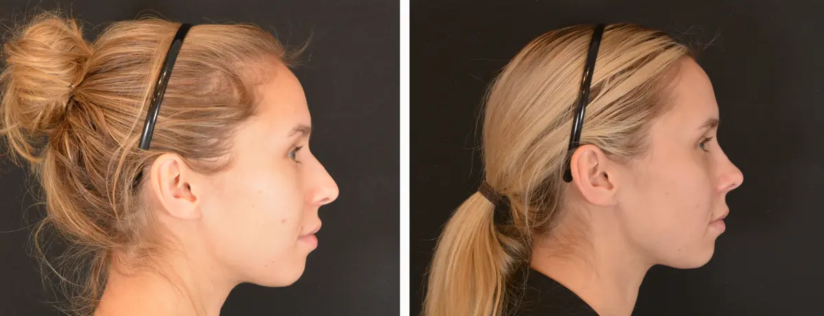 O 003 Rhinoplasty