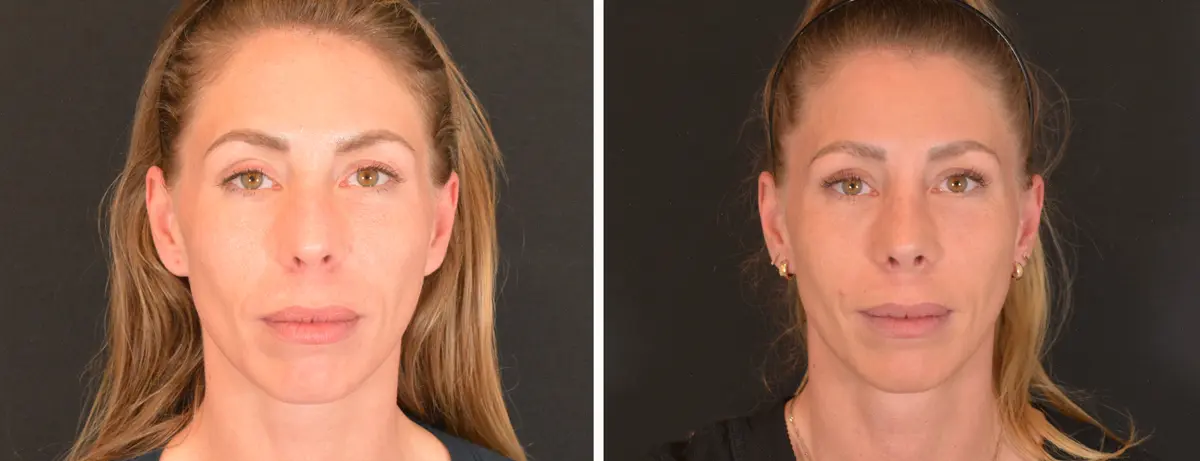 P 001 Rhinoplasty