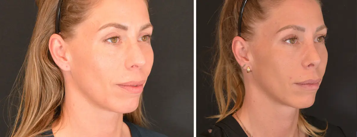 P 002 Rhinoplasty