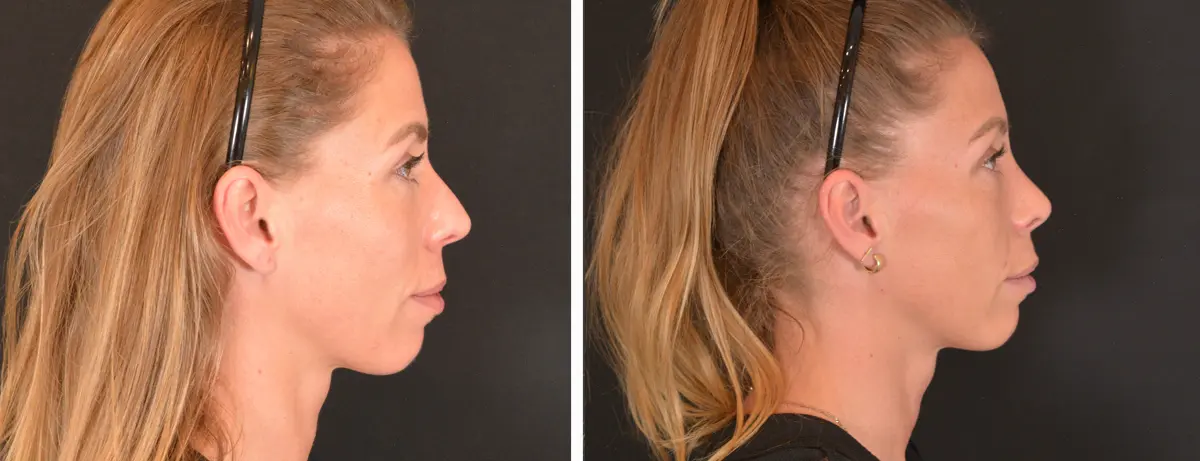 P 003 Rhinoplasty