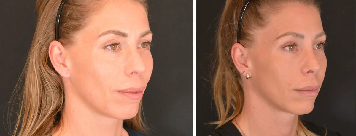 P 004 Rhinoplasty