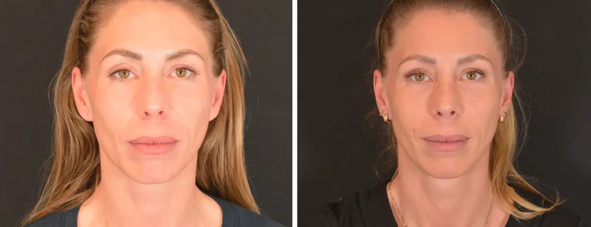 P 005 Rhinoplasty