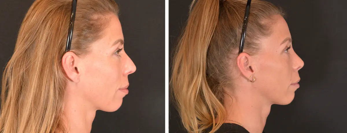 P 006 Rhinoplasty