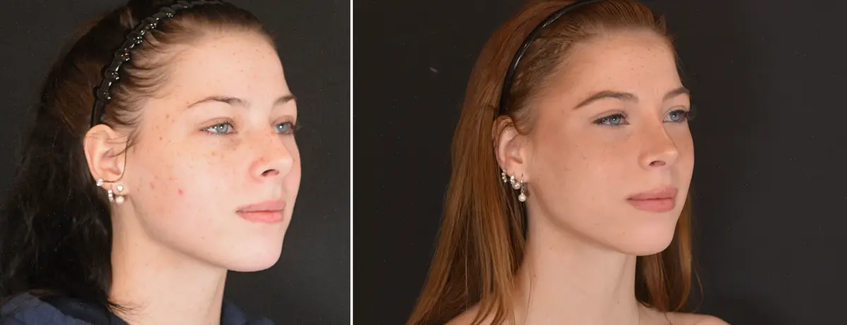 Q 002 Rhinoplasty