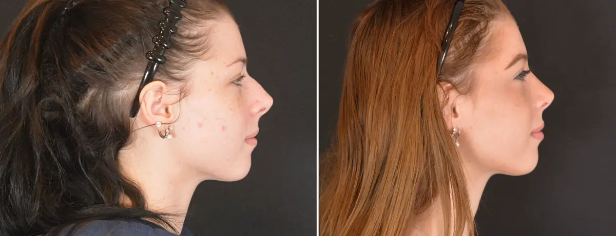 Q 003 Rhinoplasty
