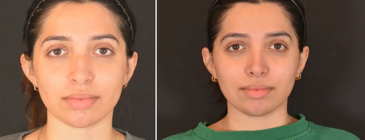 T 001 Rhinoplasty