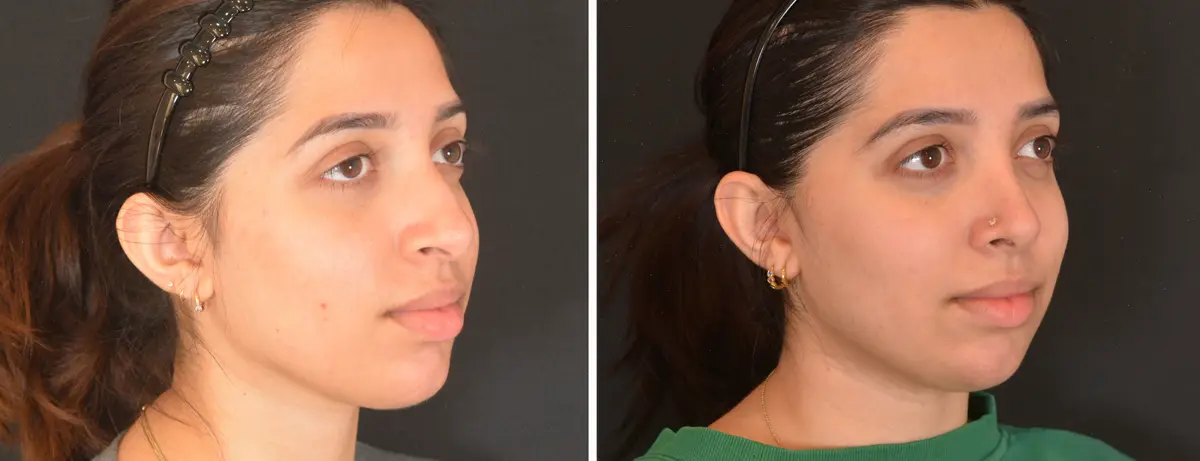 T 002 Rhinoplasty