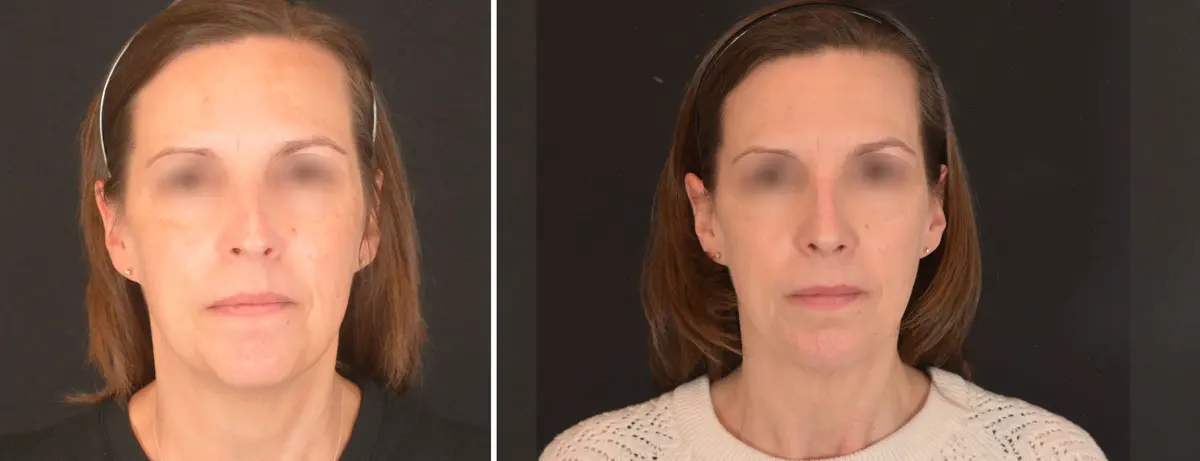 U 001 Rhinoplasty