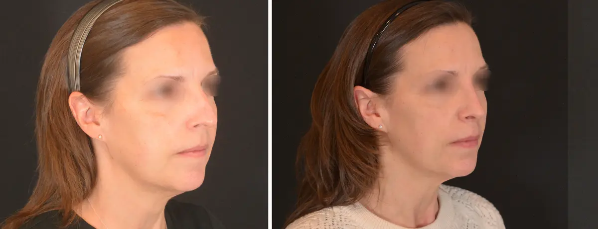 U 002 Rhinoplasty