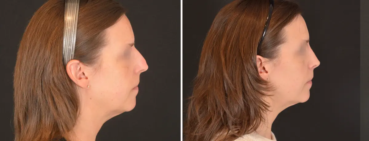U 003 Rhinoplasty