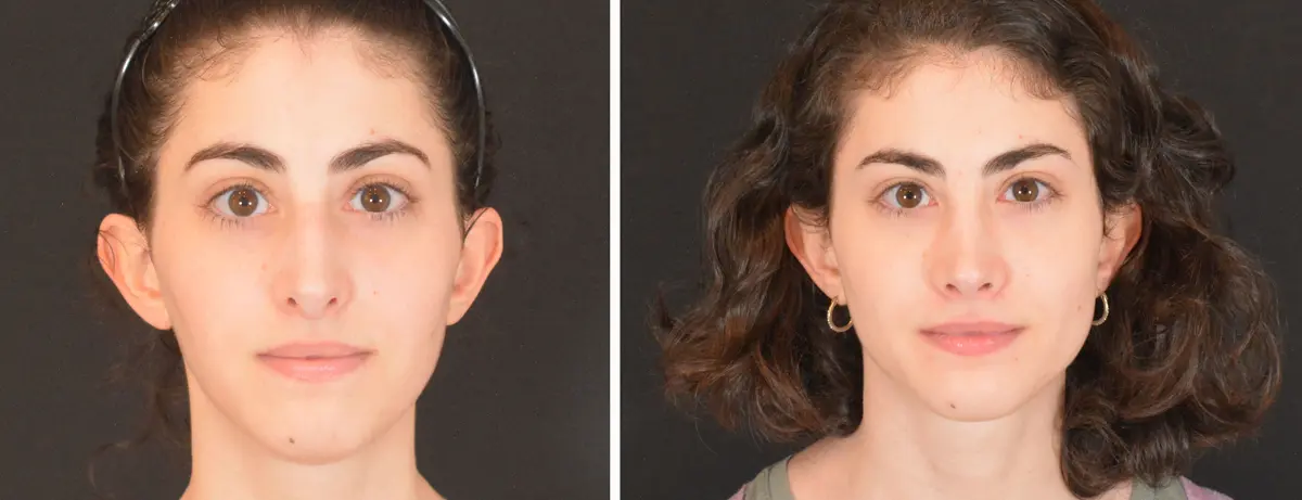 V 001 Rhinoplasty