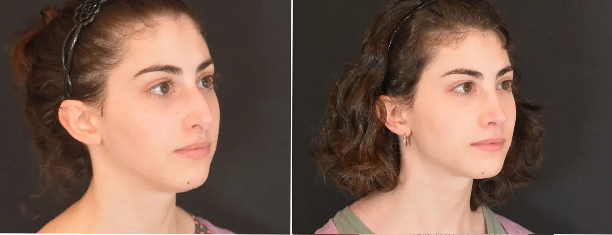 V 002 Rhinoplasty