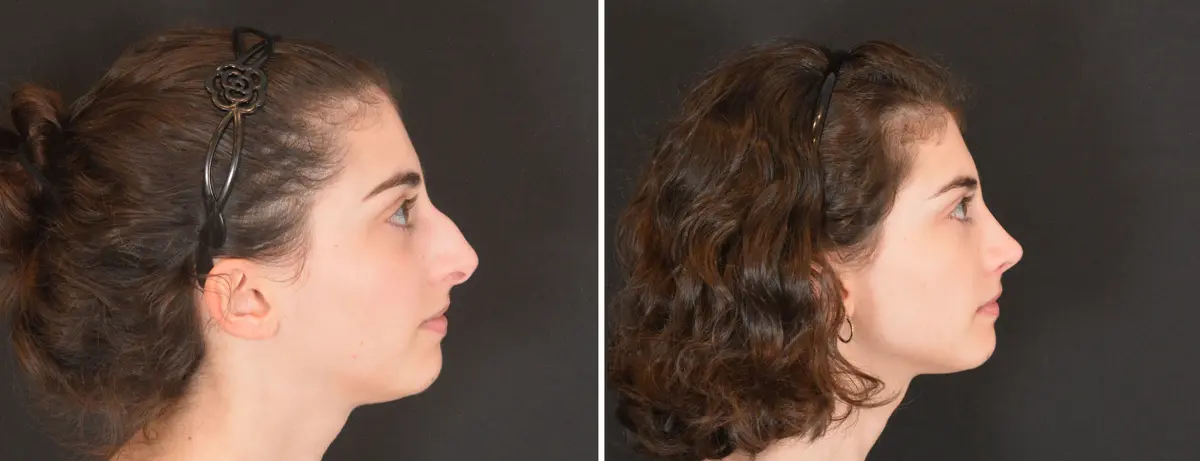 V 003 Rhinoplasty